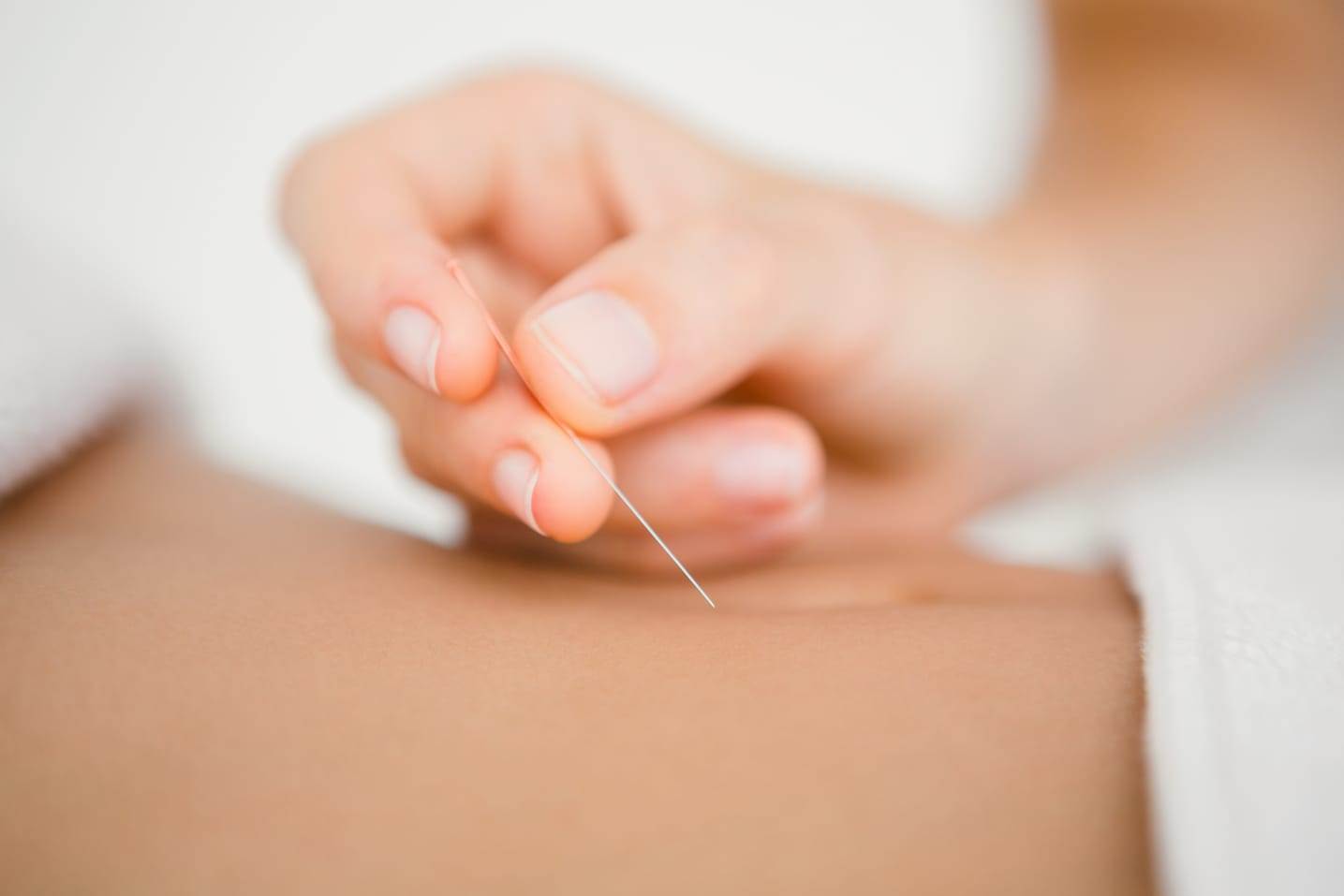 female-therapist-inserting-acupuncture-needle